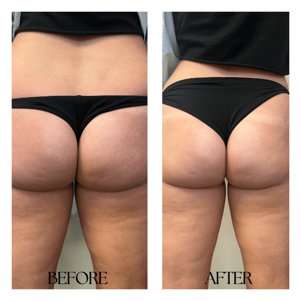 Brazilian Bum Lift - NewMe Health Clinic