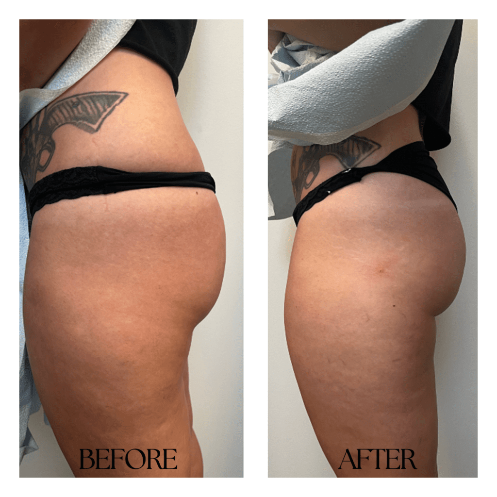 Buttocks Lift, Butt Augmentation & Sculpting