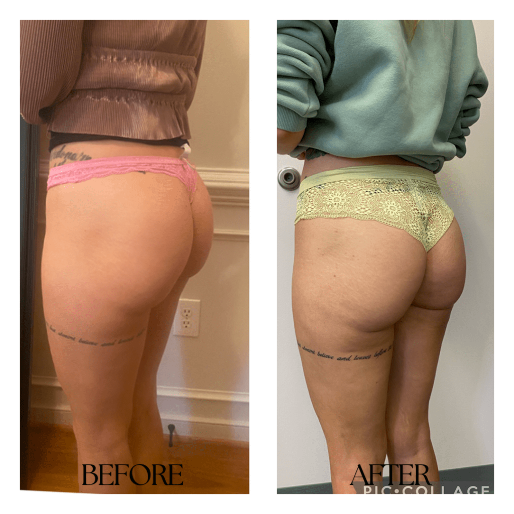 Non-Surgical Butt Lift: 12 Quick and Temporary Solutions