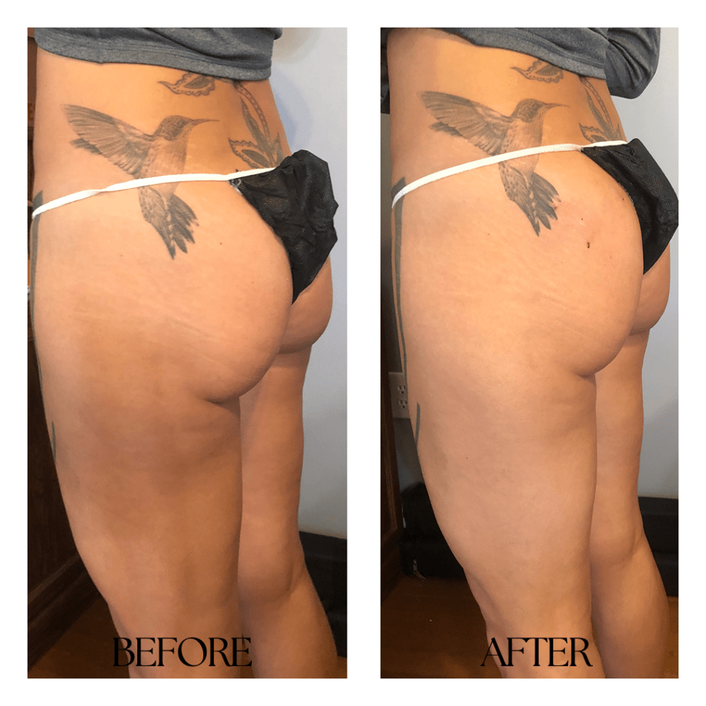 Top 3 Non-Surgical Butt Lift Treatments in San Francisco