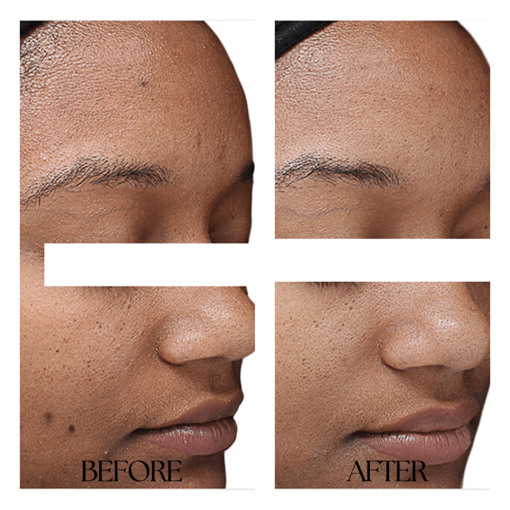 CHEMICALPEEL-before-after01