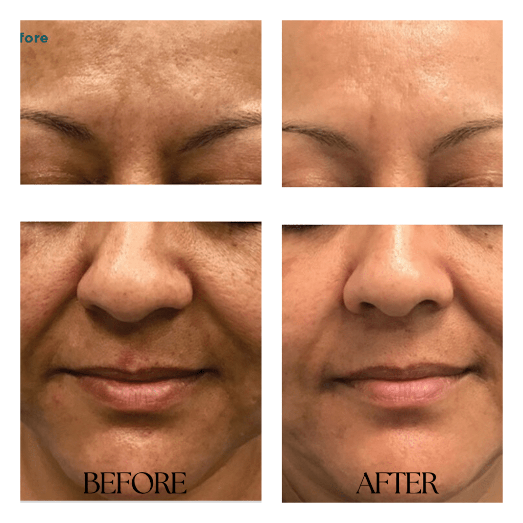 CHEMICALPEEL-before-after02