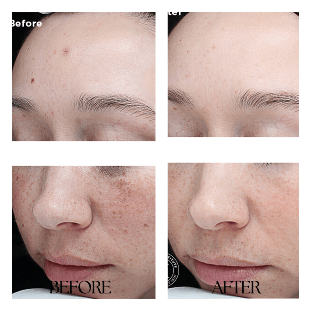 CHEMICALPEEL-before-after07