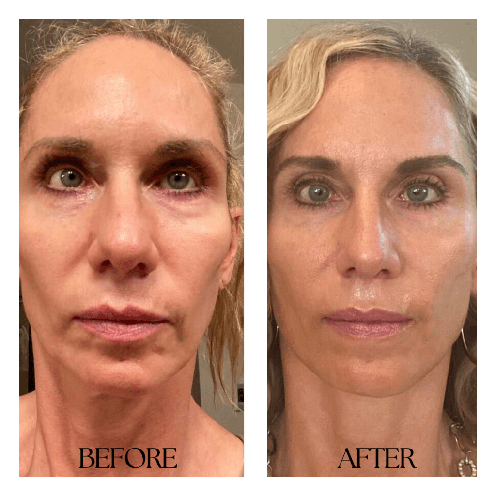 Derma_Fillers_before_after01