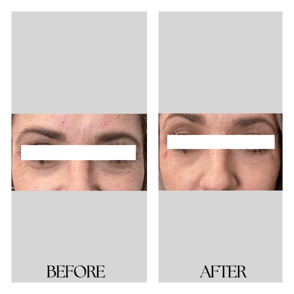 Derma_Fillers_before_after03