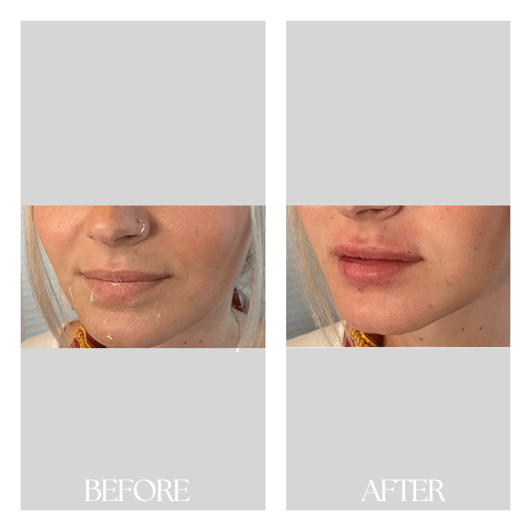 Dermal Fillers New Medical Spa