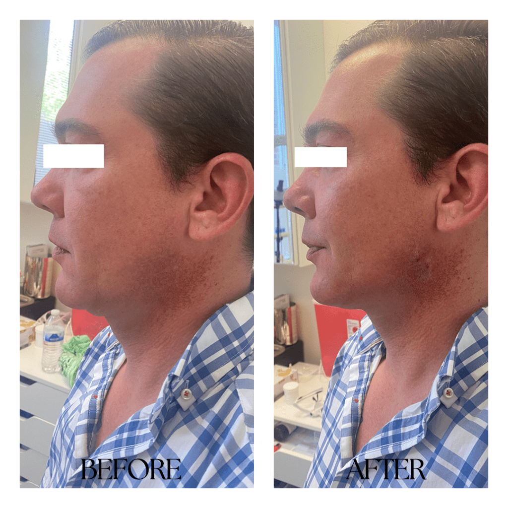 KYBELLA-before-after01