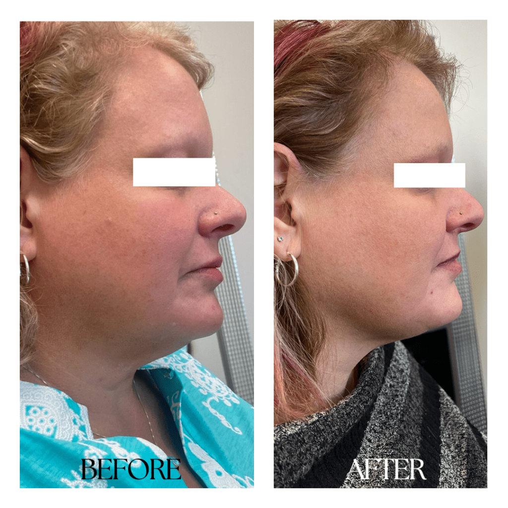KYBELLA-before-after04