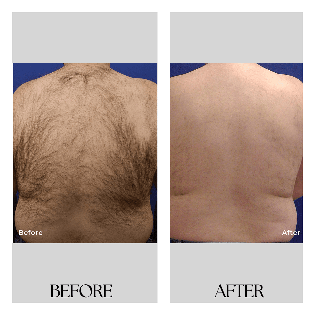 Laser hair removal near me Painless & permanent hair removal