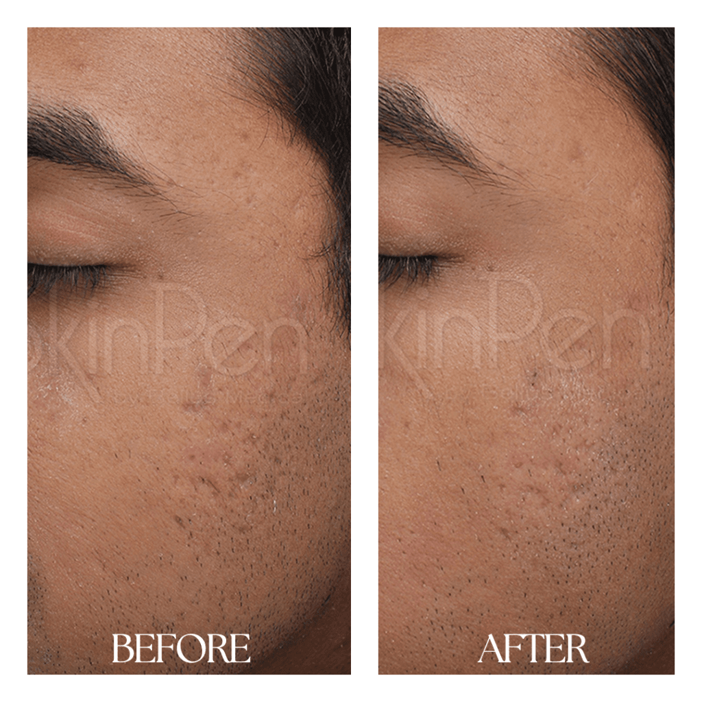 Skinpen-before-after02