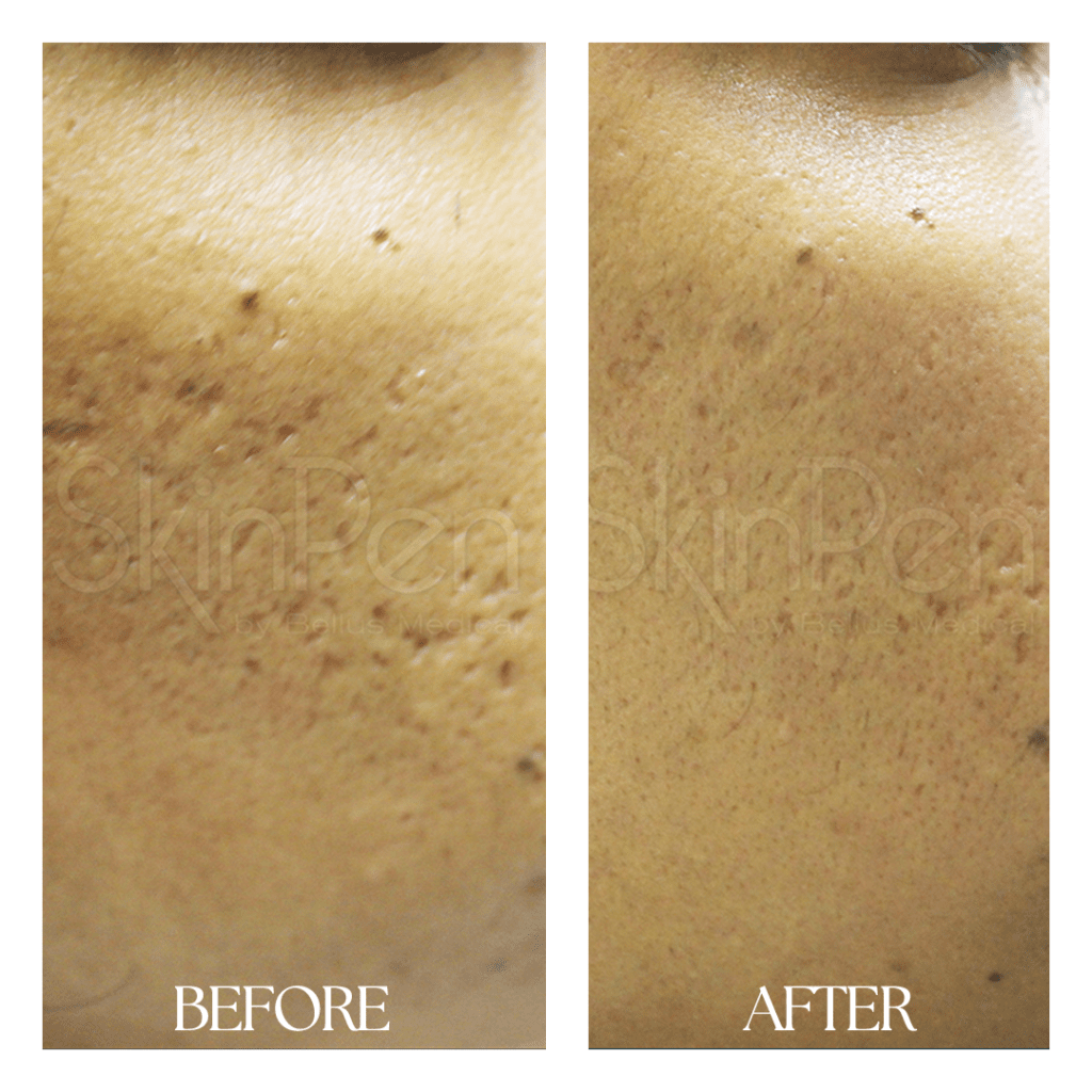 Skinpen-before-after03