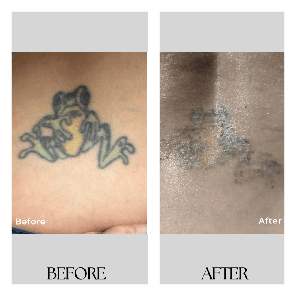 Tattoo Removal 2