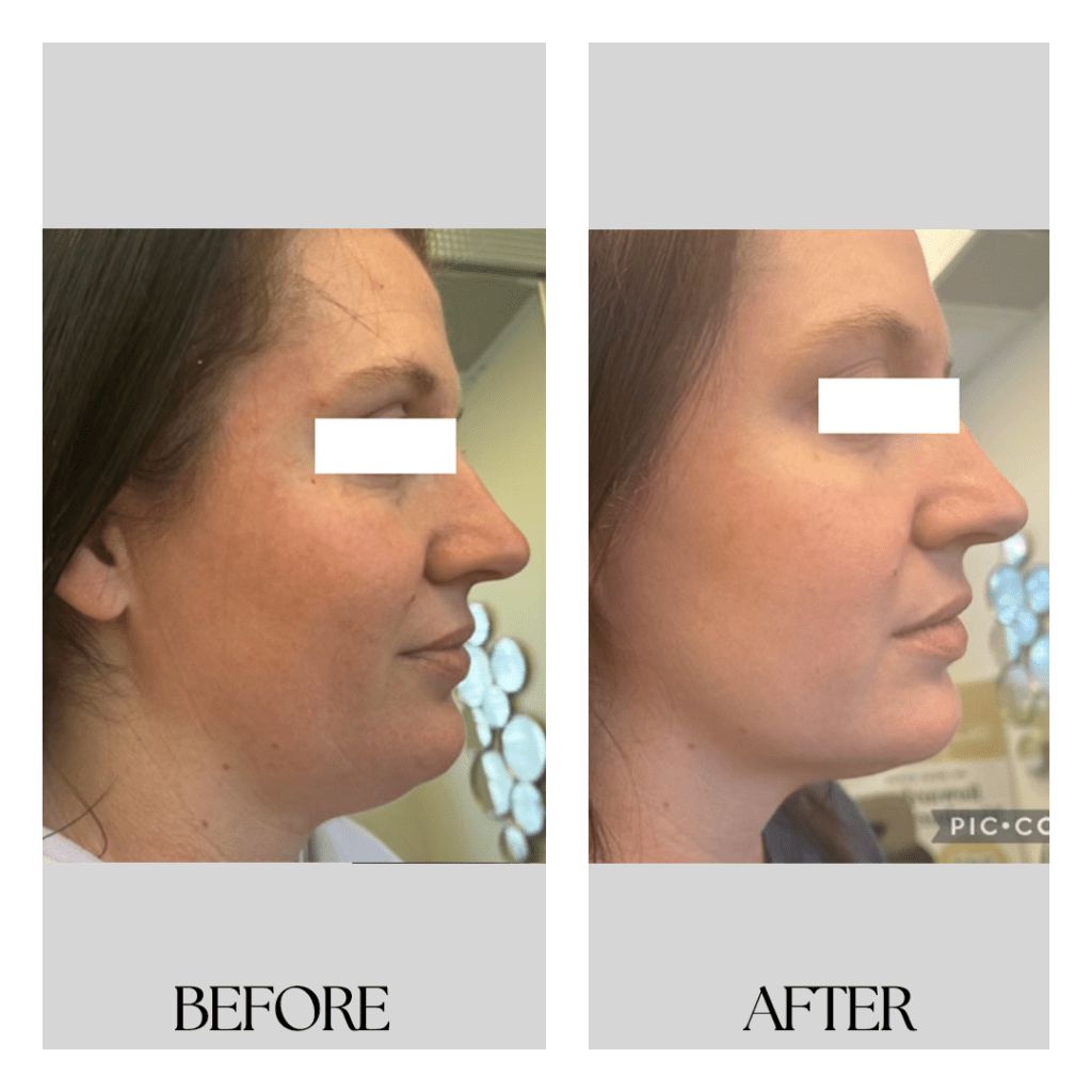ULTHERAPY-before-after03