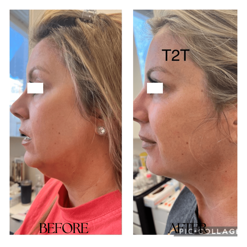 ULTHERAPY-before-after05