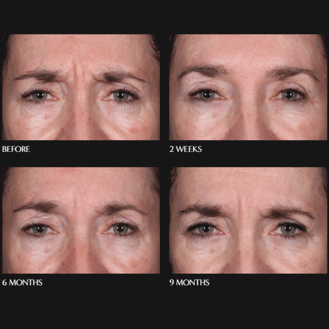 Daxxify® New Medical Spa