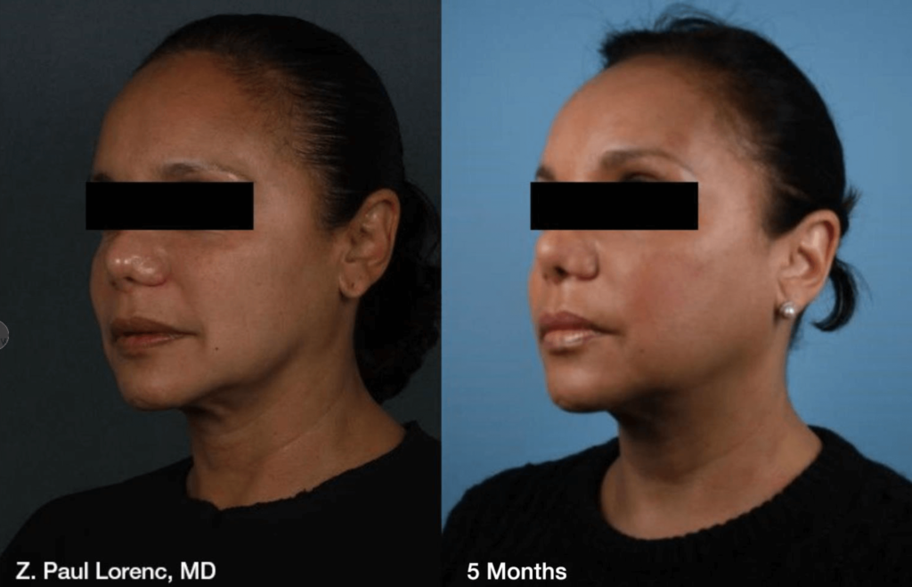 Silhouette Treatment results