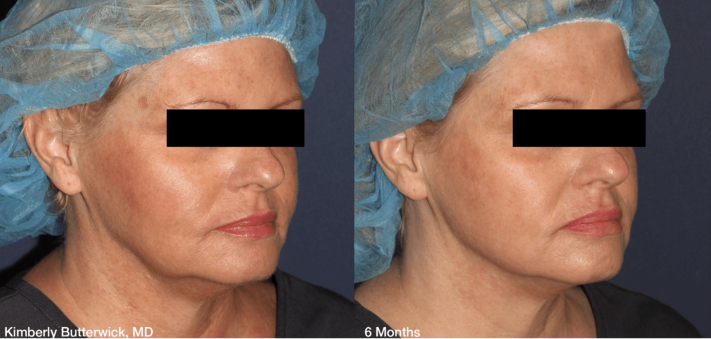 Before and After Treatment