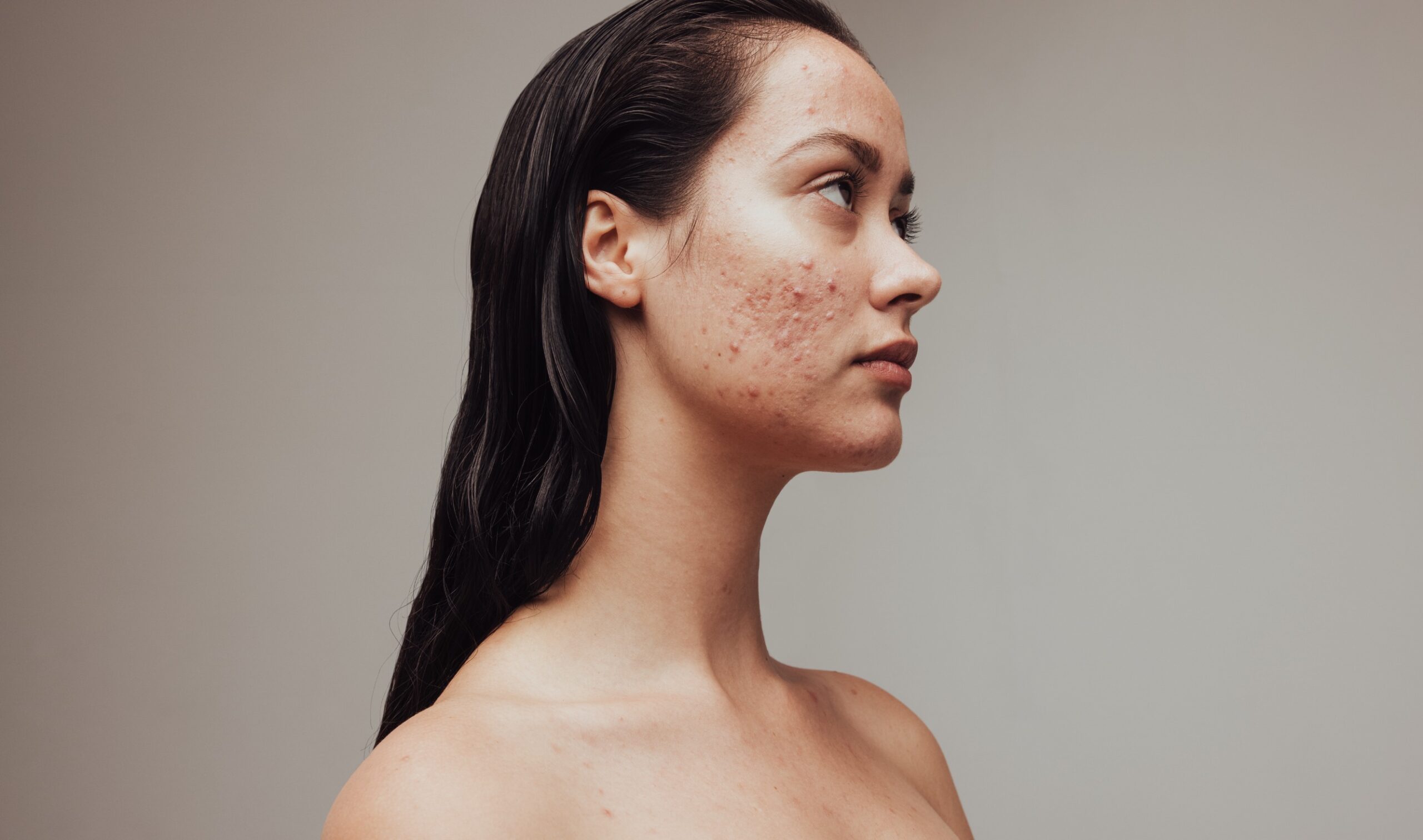 Acne and Acne Scar Treatments