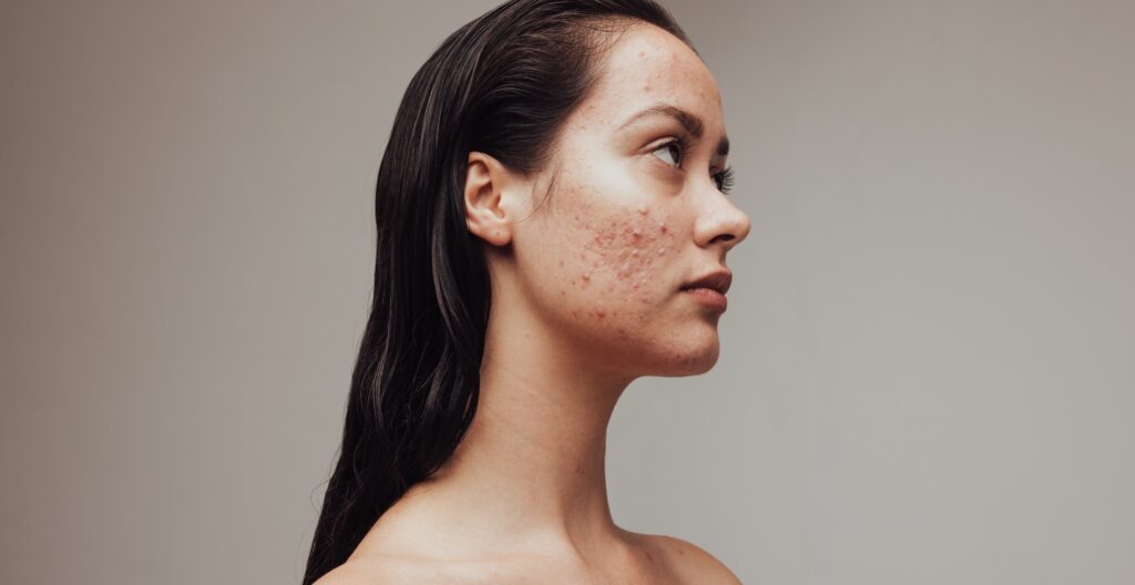 revolutionary_acne