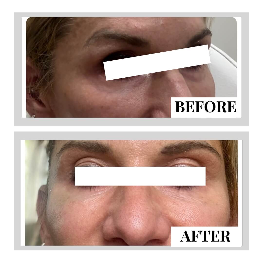 How to fix under eye hollows