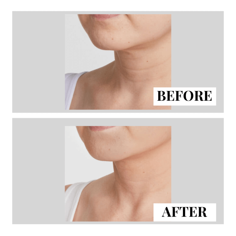 Solutions for Sagging Skin on the Body - New Medical Spa